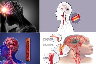 Atacul cerebral vascular reprezintă una dintre principalele cauze de deces în România Colaj DMS