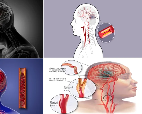 Atacul cerebral vascular reprezintă una dintre principalele cauze de deces în România Colaj  DMS