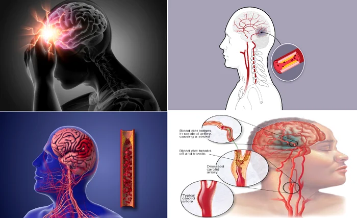 Atacul cerebral vascular reprezintă una dintre principalele cauze de deces în România Colaj DMS
