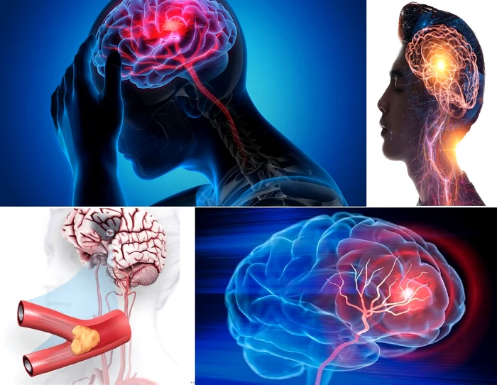 Atacul cerebral vascular reprezintă una dintre principalele cauze de deces în România Colaj DMS