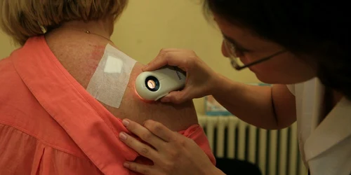 Medicul dermatolog face o consultaţie unei paciente pentru depistarea cancerului de piele