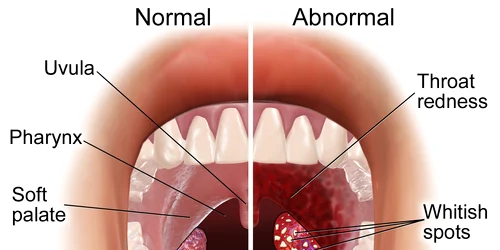 Blausen 0860 Tonsils&Throat Anatomy png